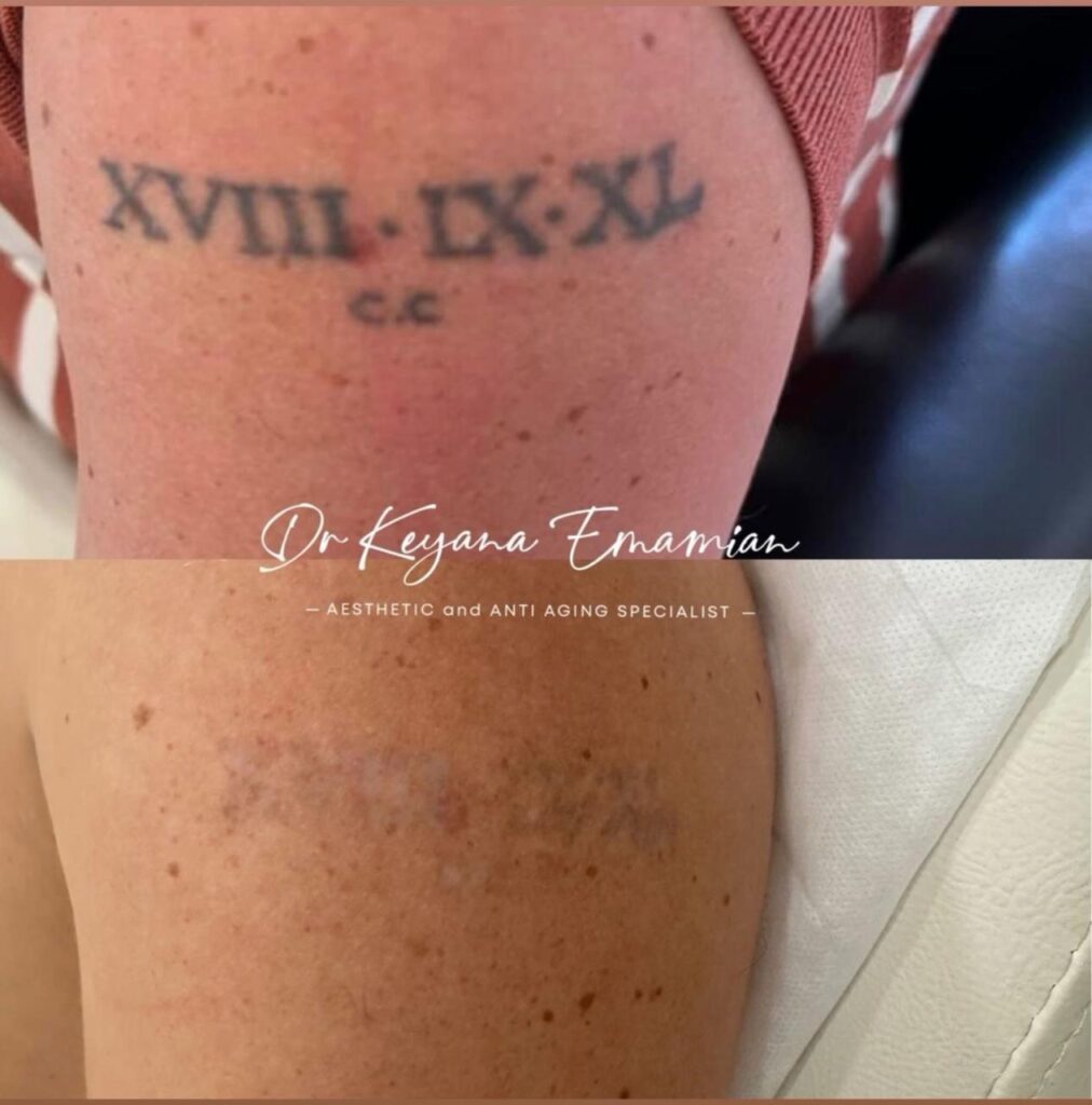 Tattoo removal with Picolaser