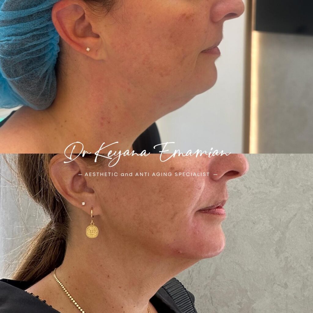 Tattoo removal with Picolaser