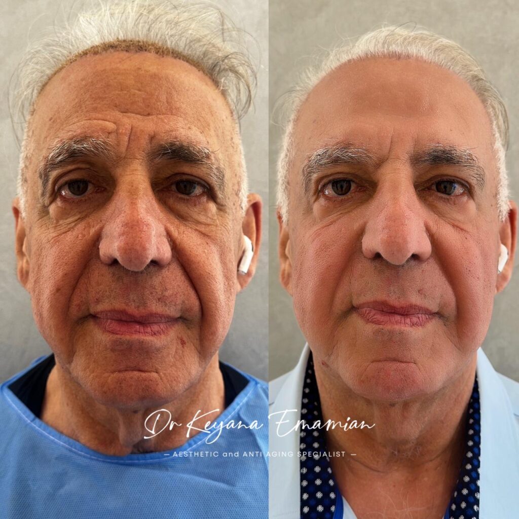 Non surgical facelift with Endolift