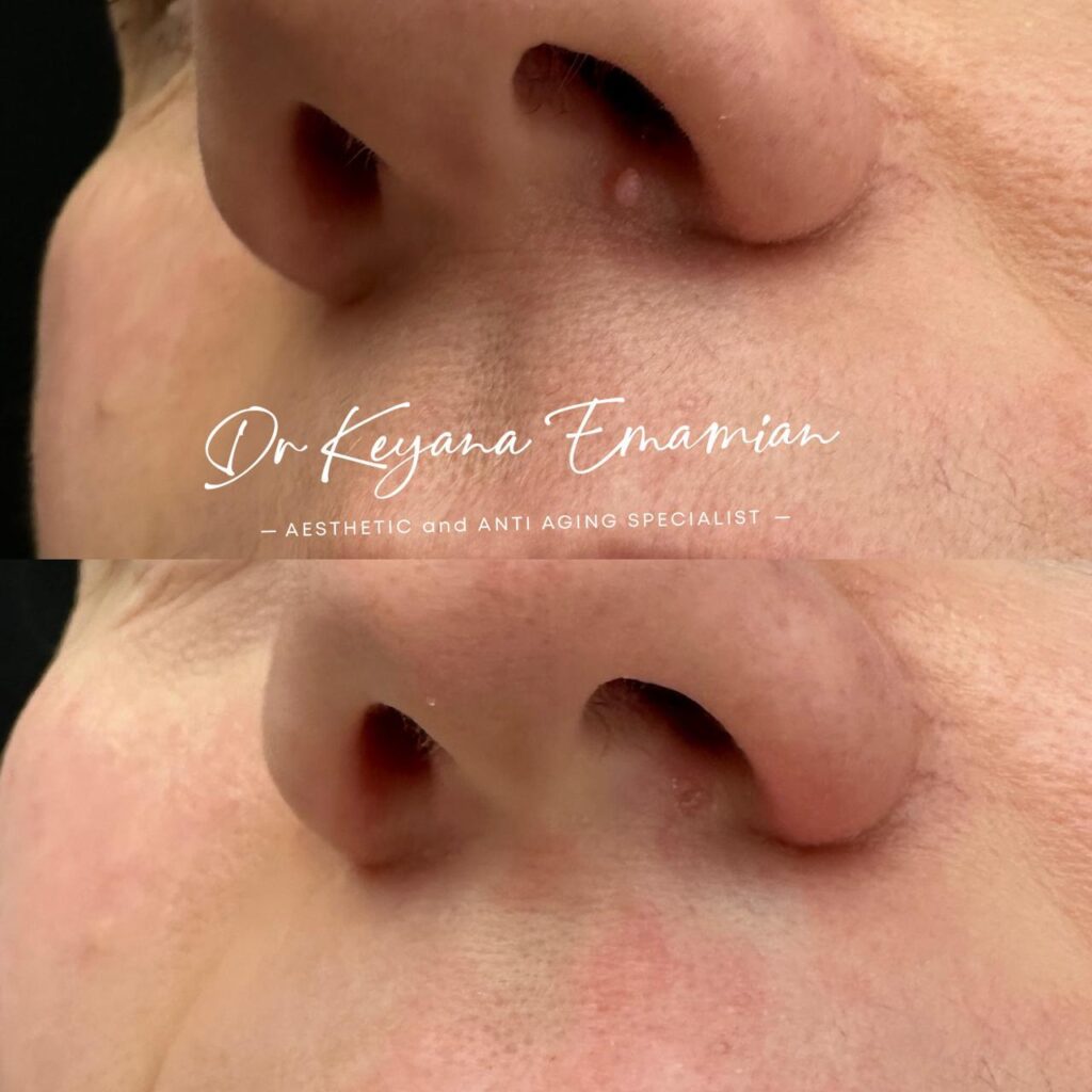 Lesion removal with laser
