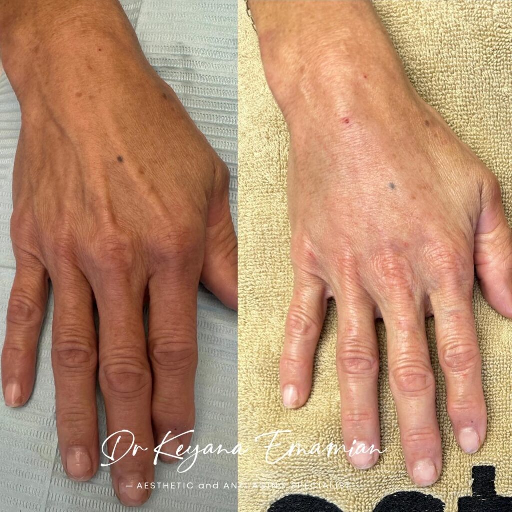Hand treatment