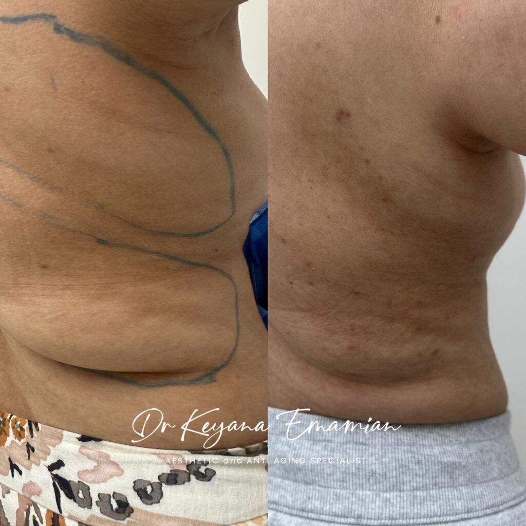 Local fat removal with Endolift