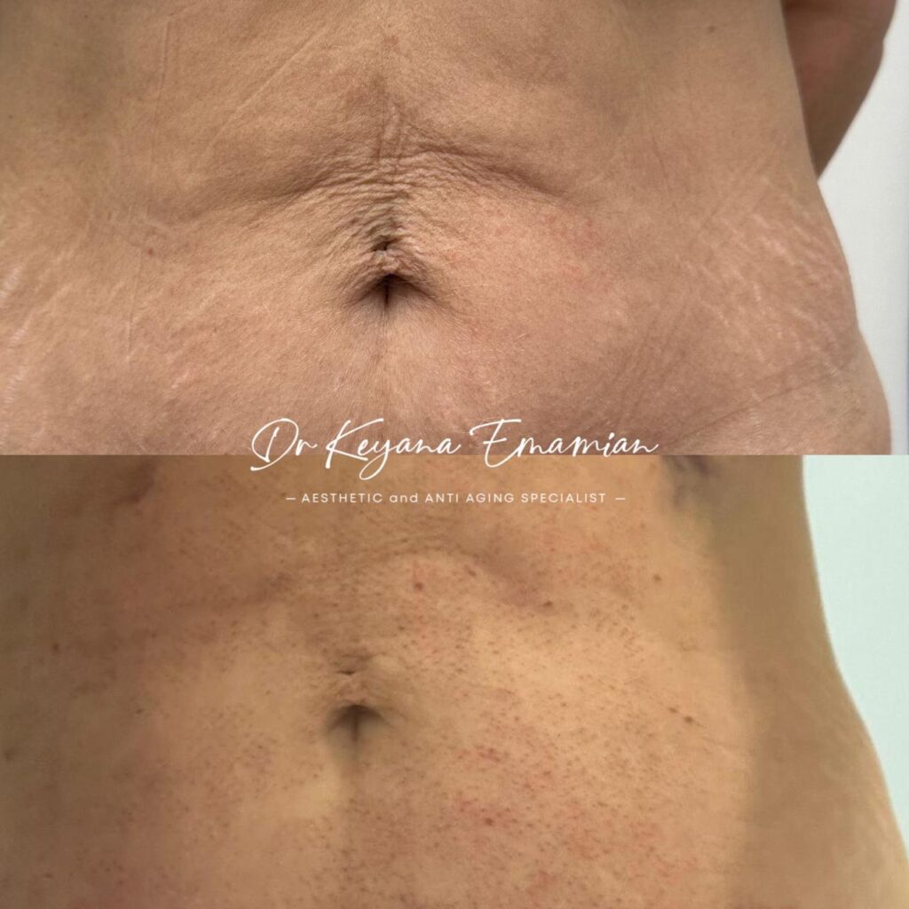 Body tightening with Endolift+Morpheus
