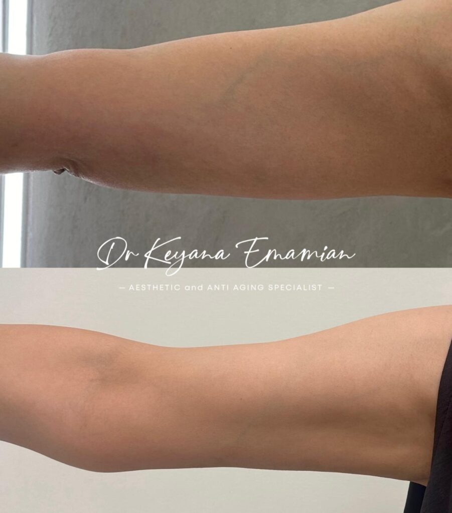 Arm tightening with Endolift