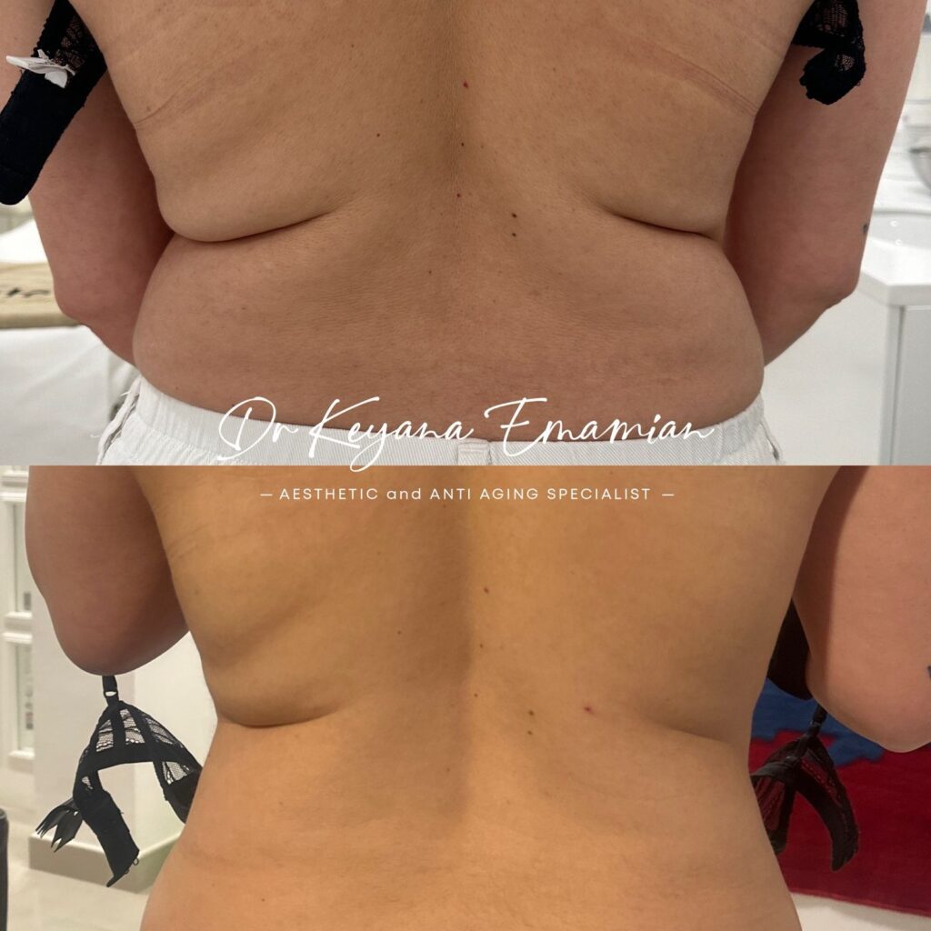 Local fat removal with Endolift