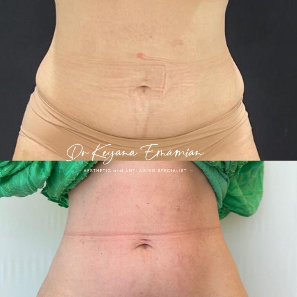 Local fat removal with Endolift + Morpheus + Fat dissolving