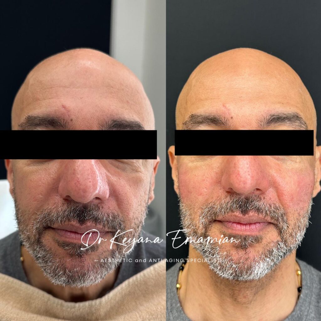 Male face harmonization with biostimulator
