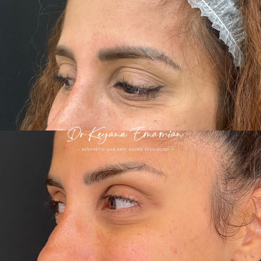 Eye treatment with Salmon DNA ( Polynucleotide)