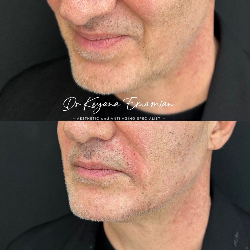 Lower face treatment with PRF