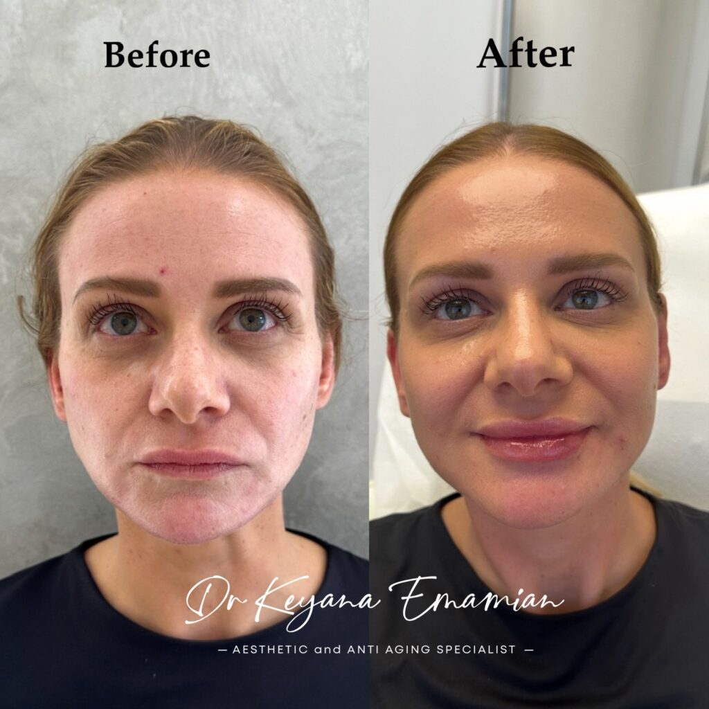 Face rejuvenation with Biostimulator and Exosome
