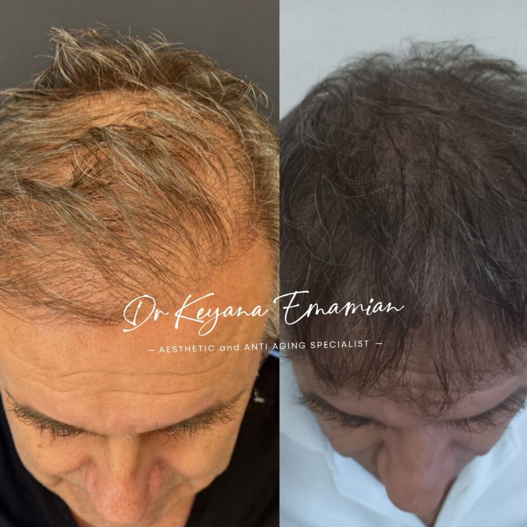 Hair treatment with PRF+Growth factor + Exosome