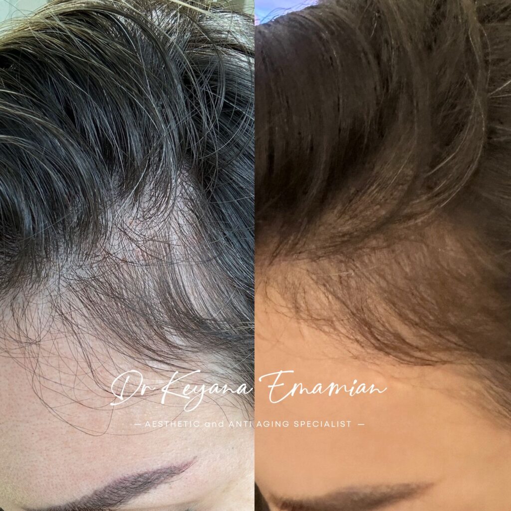 Hair treatment with Exosome+ PRF