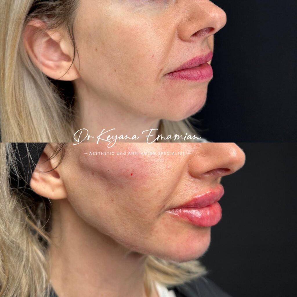 Face harmonization with filler