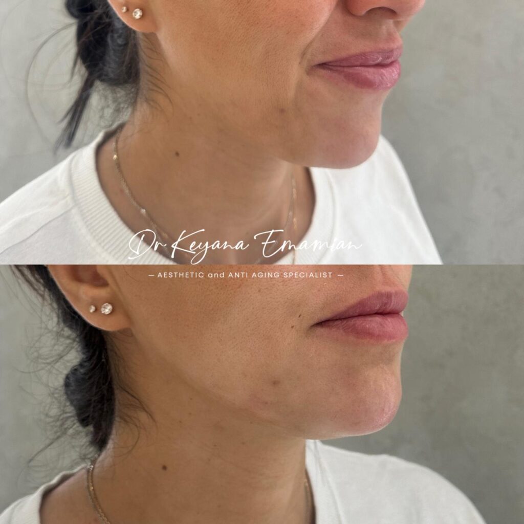 Face harmonization with filler