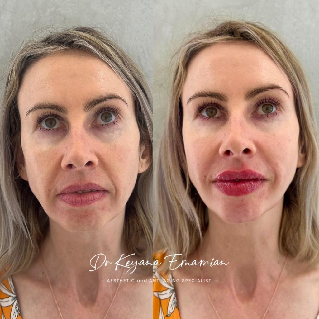 Face harmonization with filler