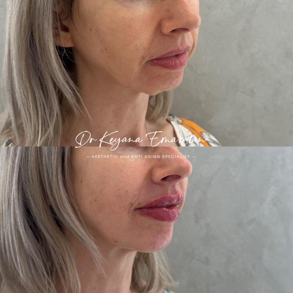 Face harmonization with filler