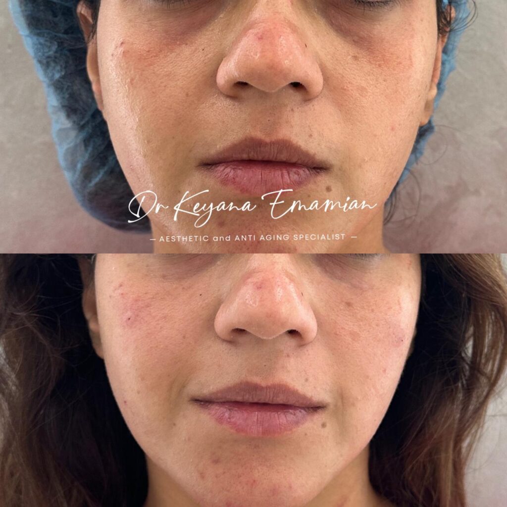 Face harmonization with filler
