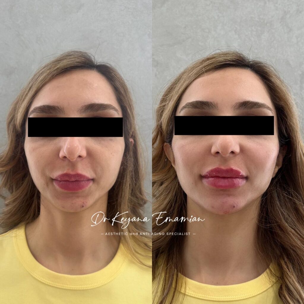 Face harmonization with filler