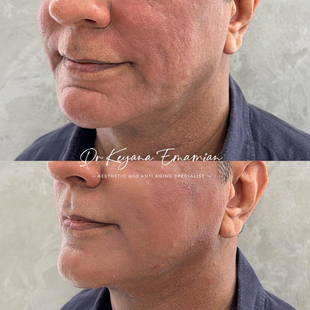 Face harmonization with filler