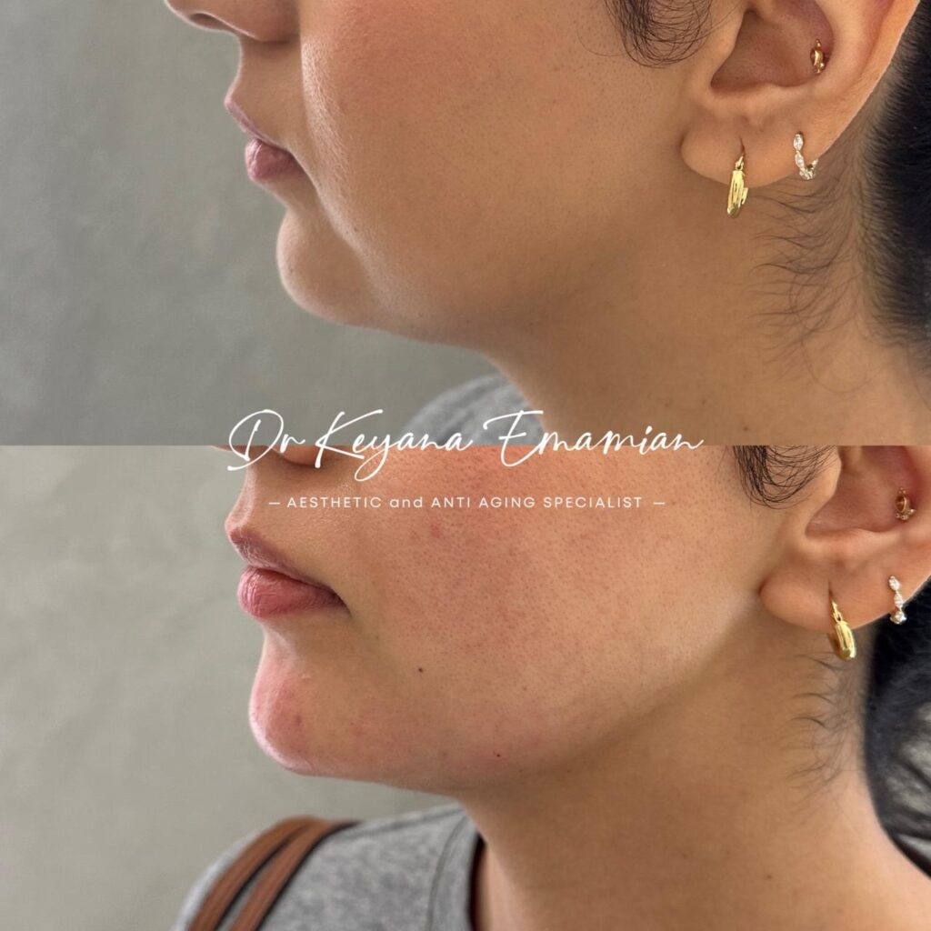Face harmonization with filler