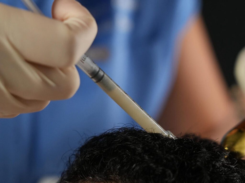 Expert Hair Treatments in Dubai with Dr. Keyana: PRF, Exosomes, Mesotherapy, and Growth Factor Therapies